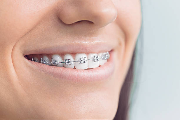 Dental Bonding in Cambridge, IL